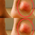 The Best Natural Gout Treatments: Remove Uric Acid Crystallization To Prevent Gout And Joint Pain